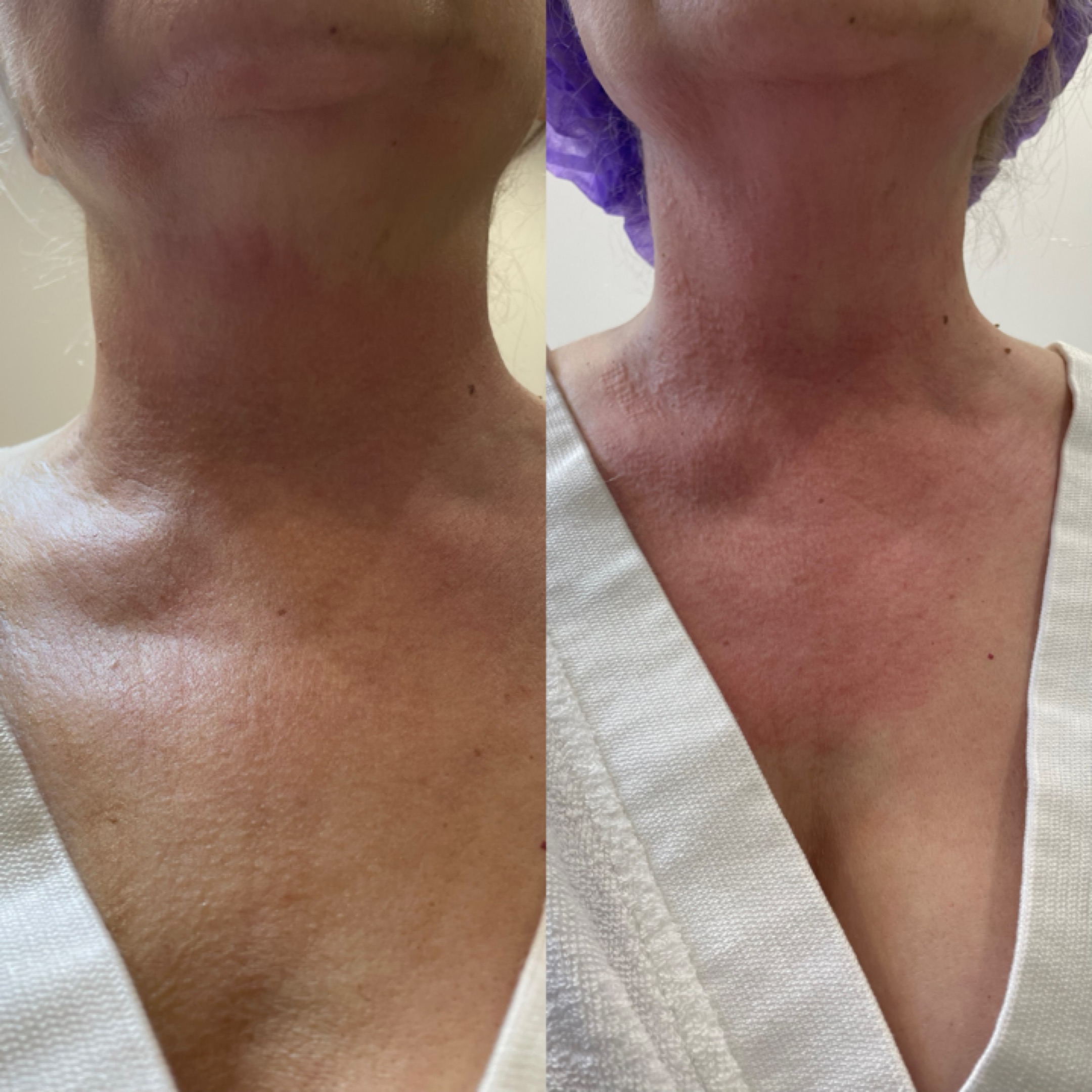 Микроголковый RF-лифтинг 2 — результат до/после