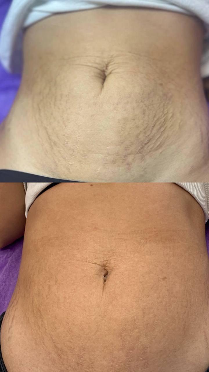 Микроголковый RF-лифтинг — результат до/после