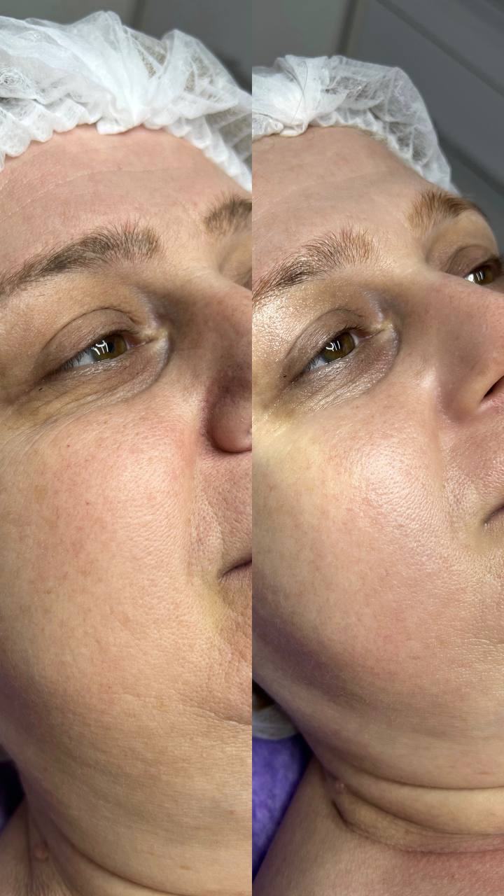 Пилинг PRX-T33 — результат до/после