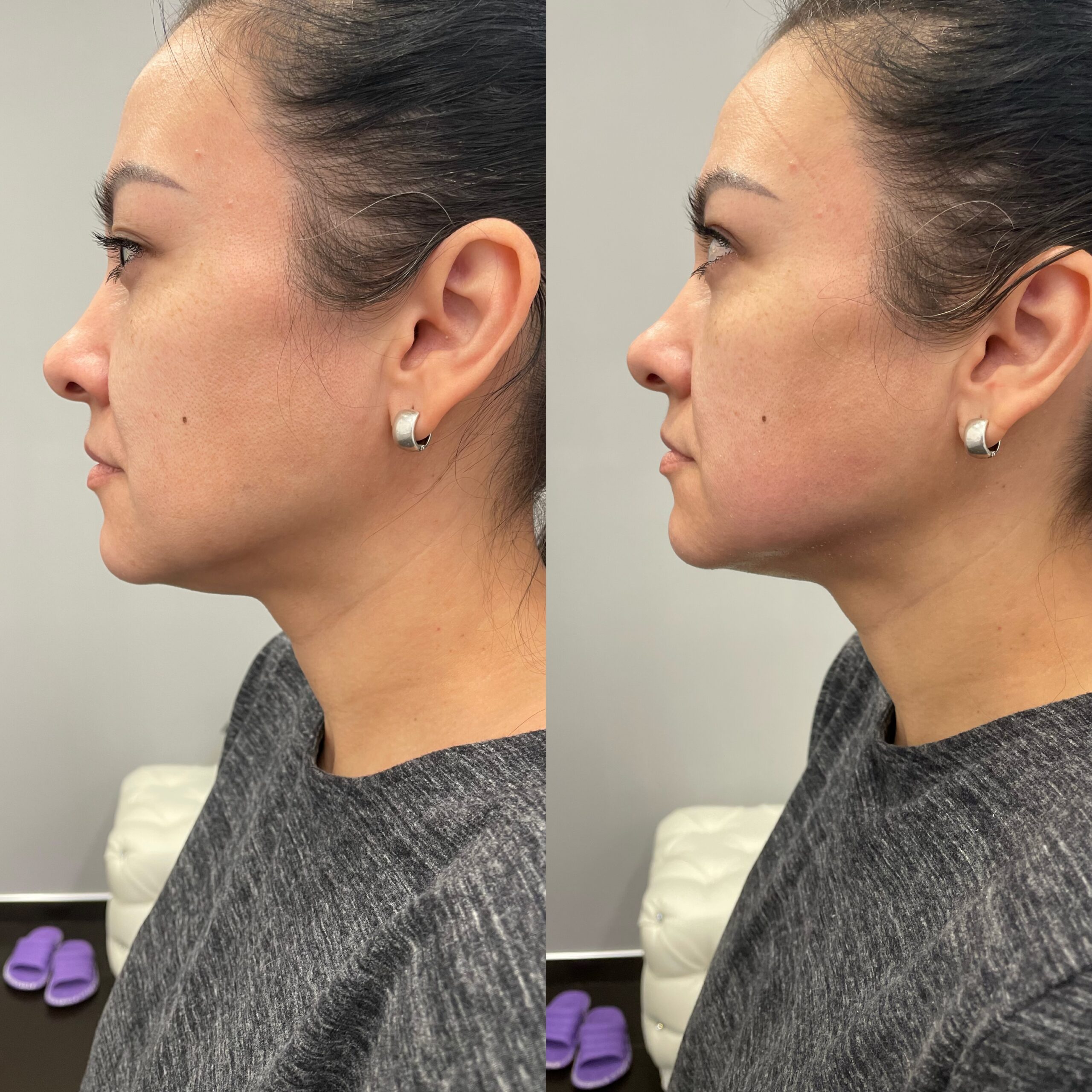 SMAS-лифтинг 2 — результат до/после