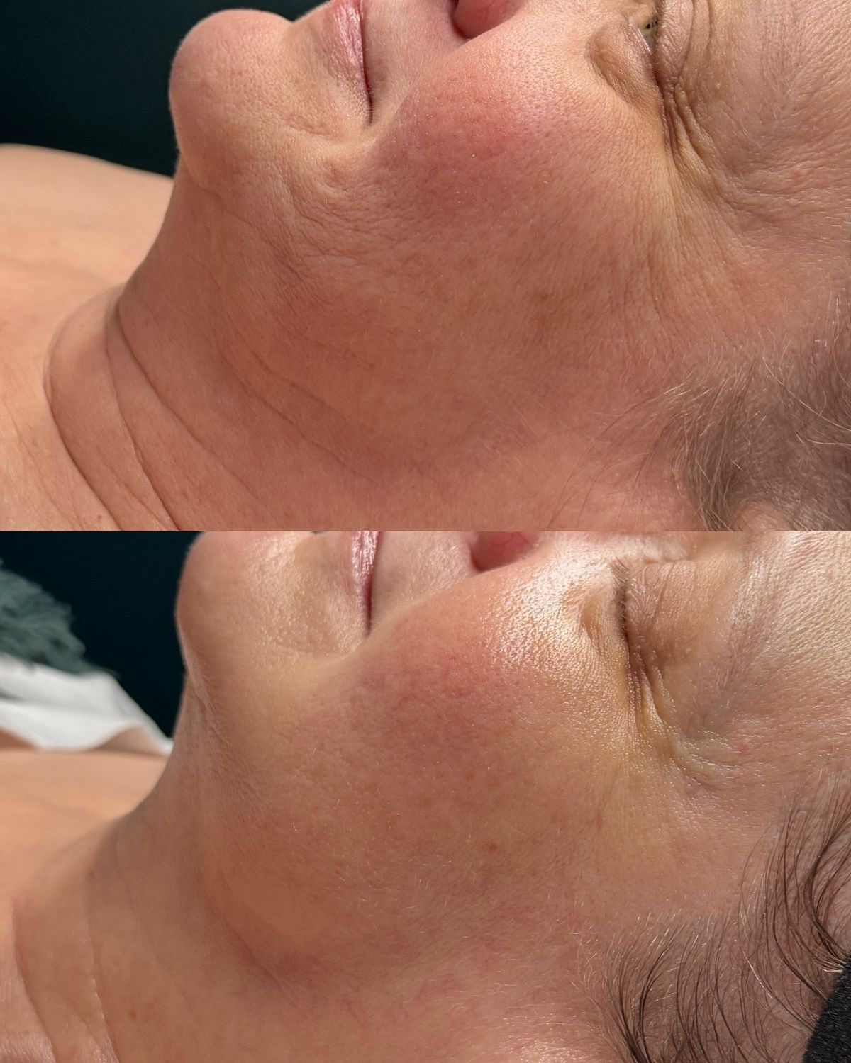 SMAS-лифтинг 3 — результат до/после