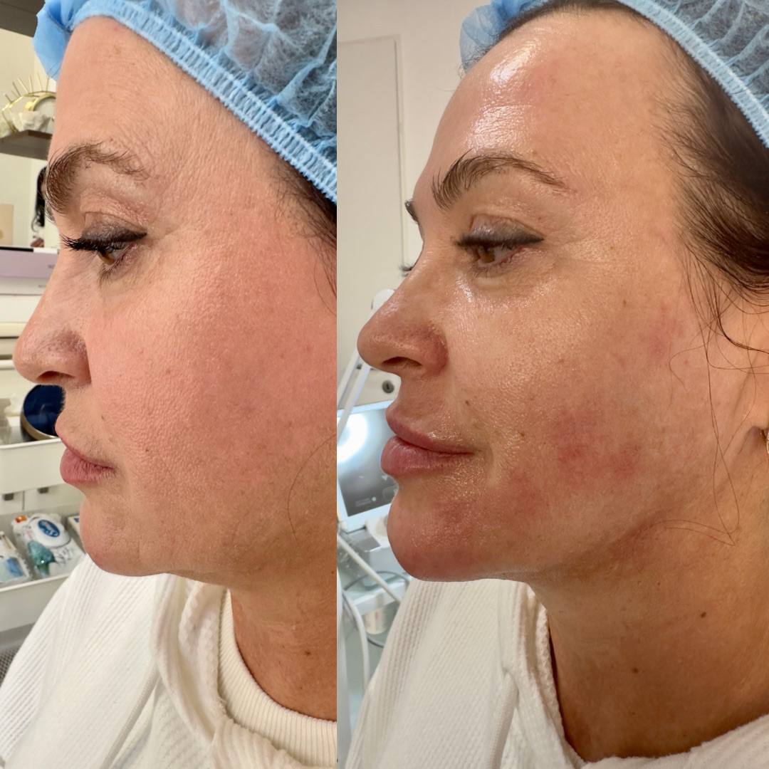 SMAS-лифтинг 6 — результат до/после