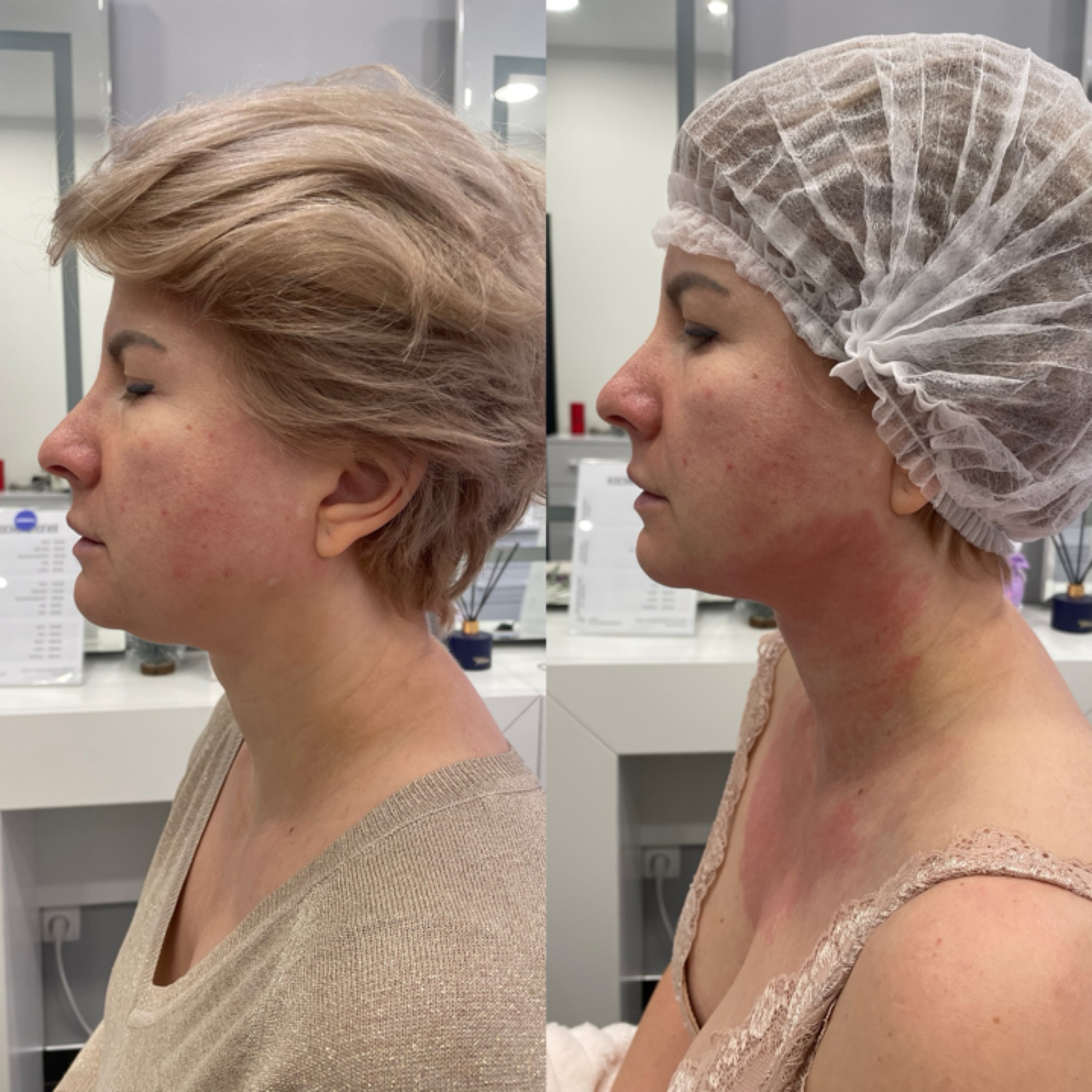 SMAS-лифтинг — результат до/после