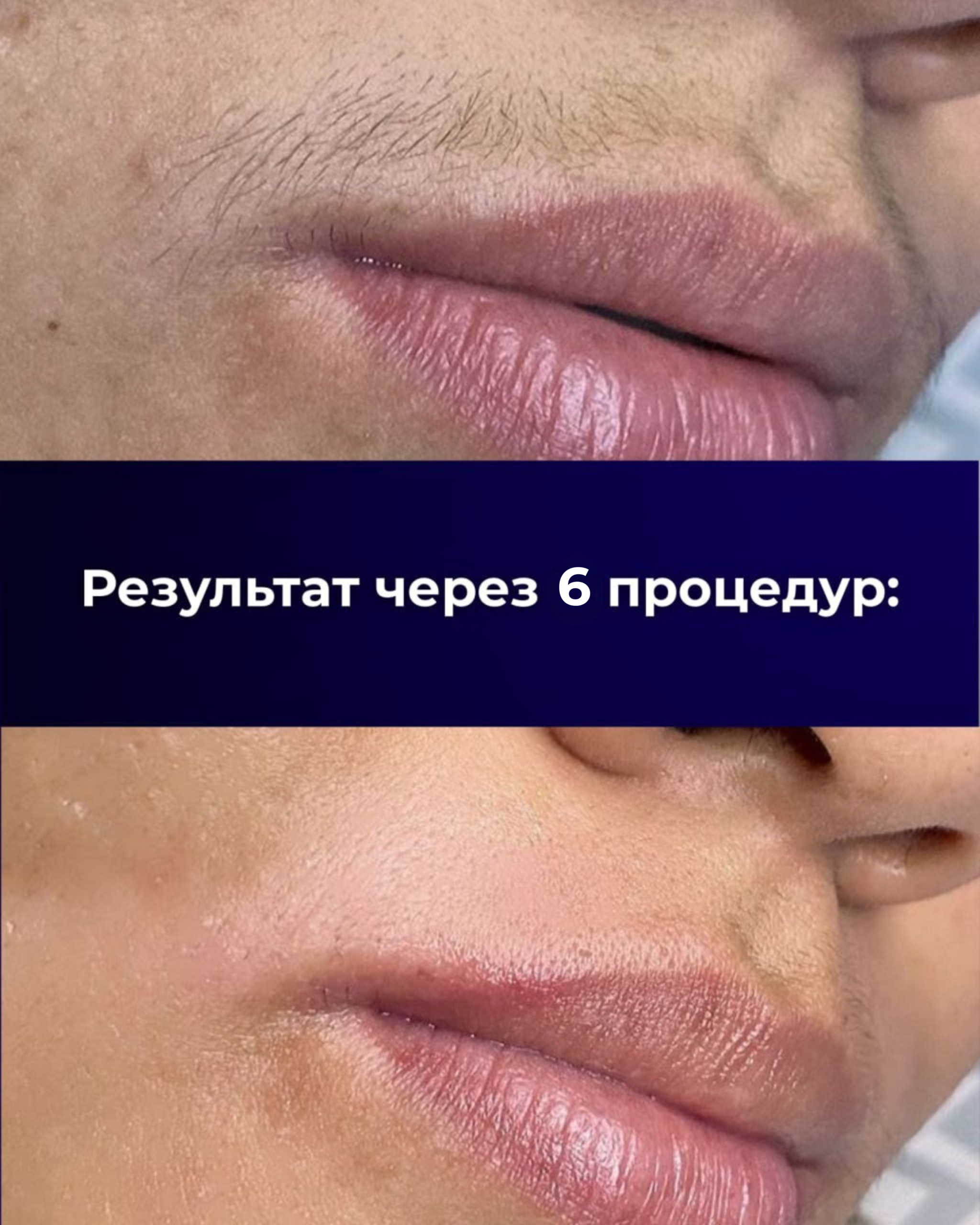 Лазерная эпиляция — результат до/после