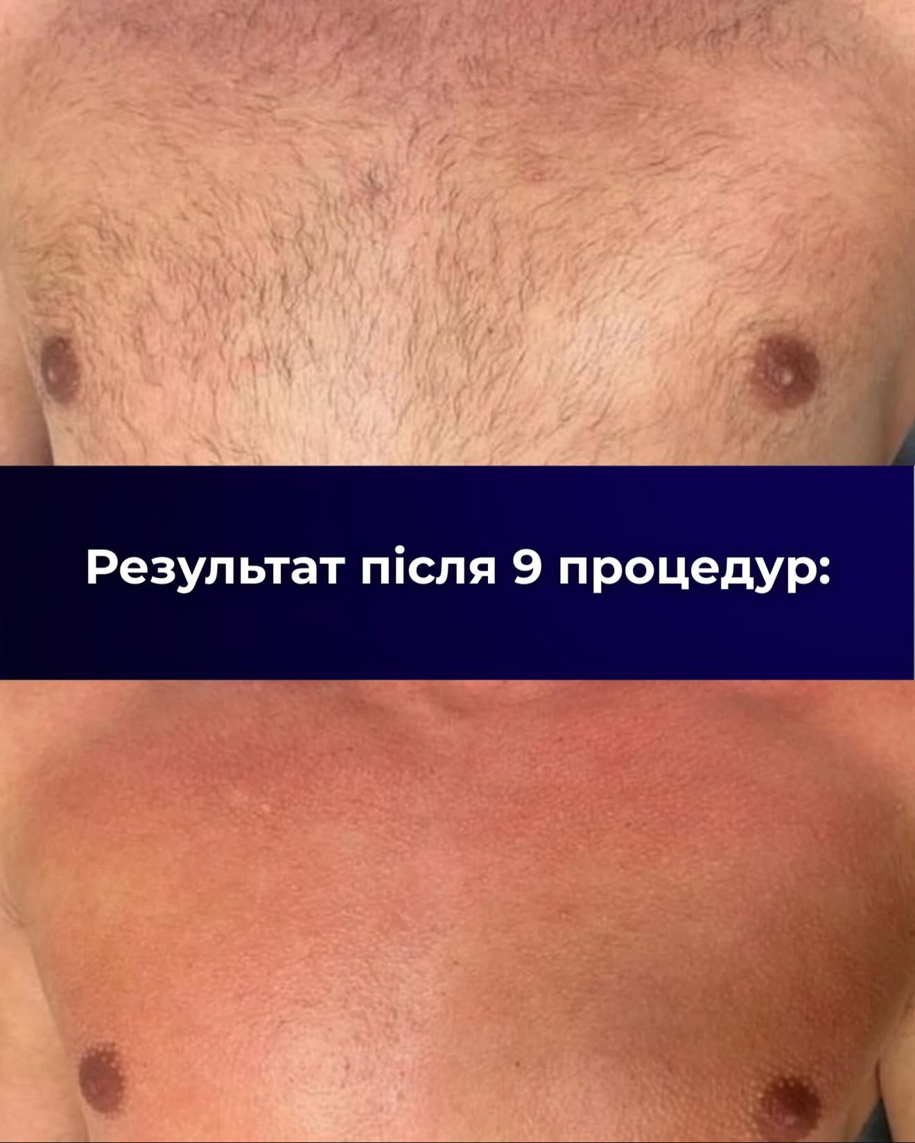 Лазерная эпиляция 3 — результат до/после