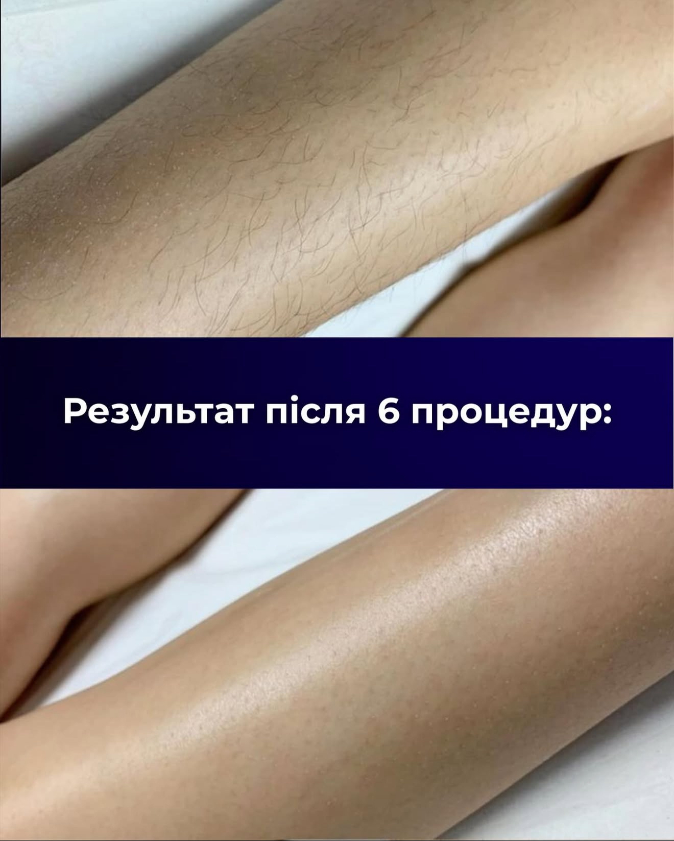 Лазерная эпиляция 5 — результат до/после