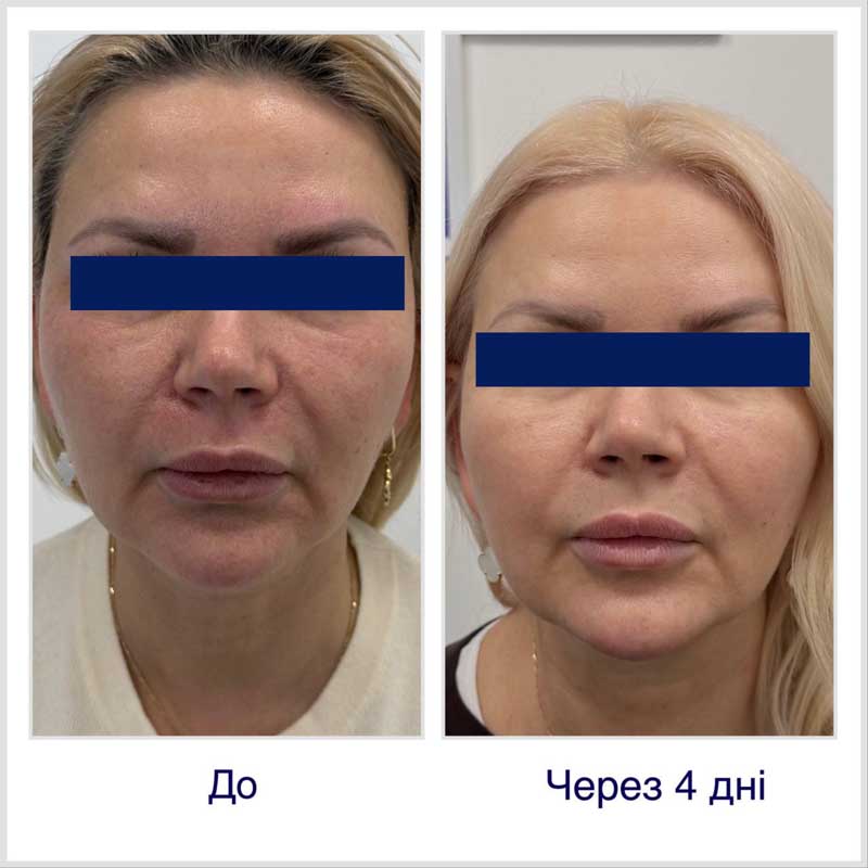 SMAS-лифтинг (Блюр-1) — результат до/после