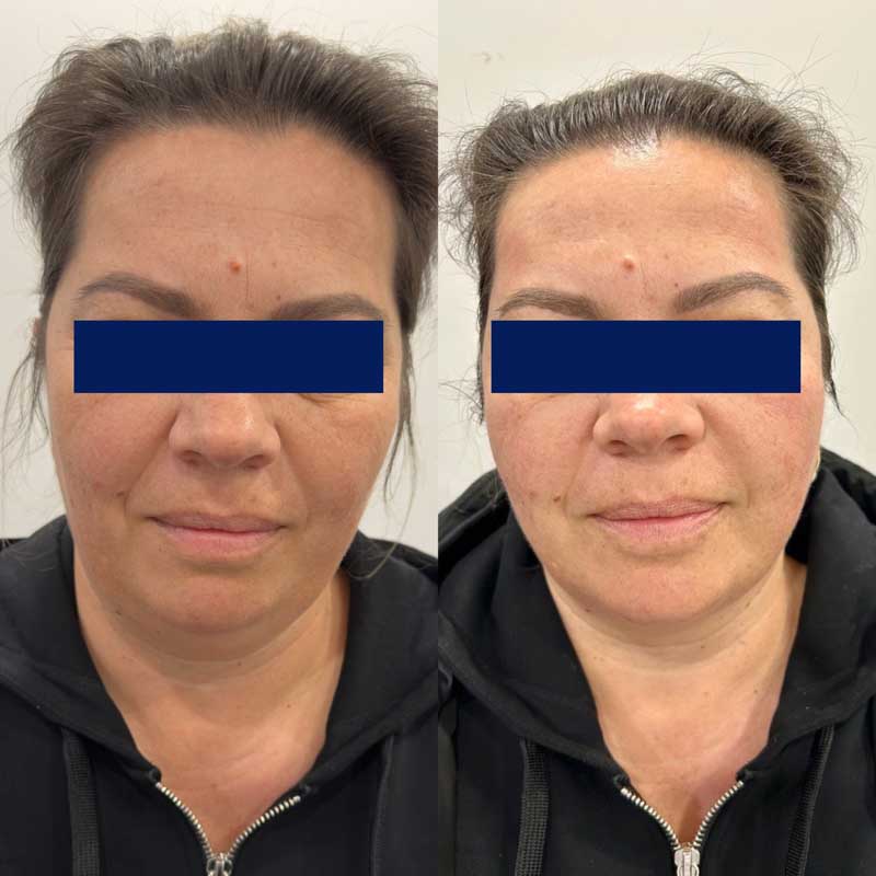 SMAS-лифтинг (Блюр-10) — результат до/после