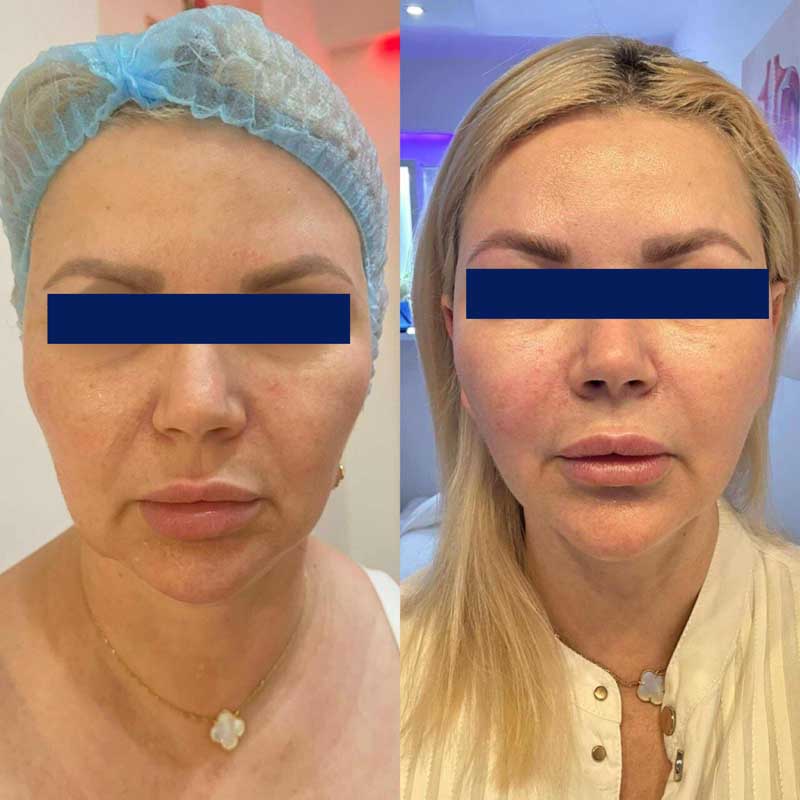 SMAS-лифтинг (Блюр-11) — результат до/после