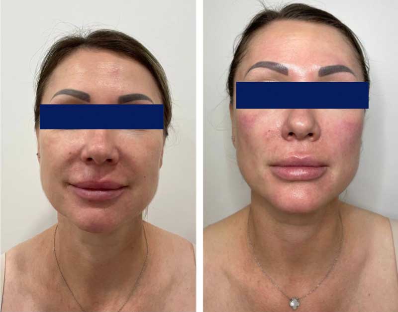 SMAS-лифтинг (Блюр-12) — результат до/после