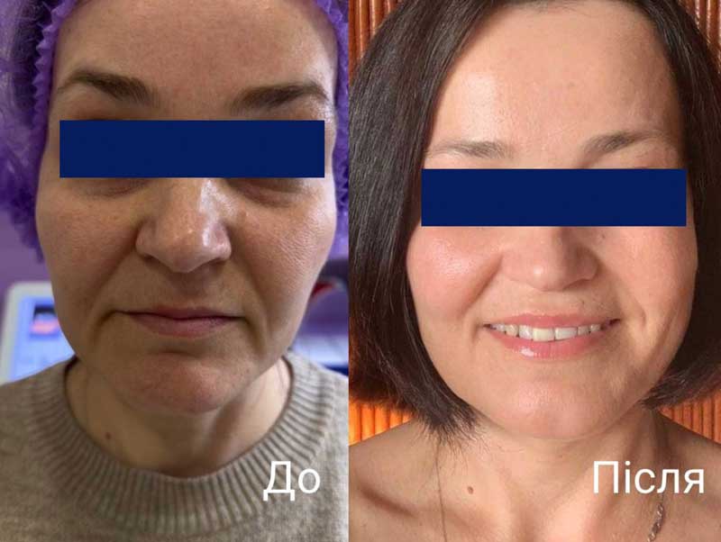 SMAS-лифтинг (Блюр-13) — результат до/после