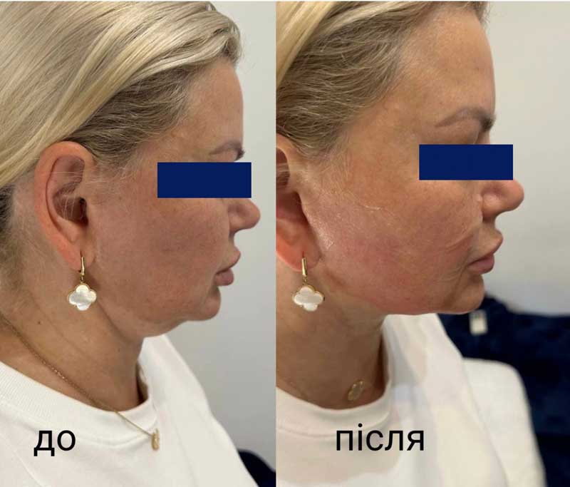 SMAS-лифтинг (Блюр-14) — результат до/после
