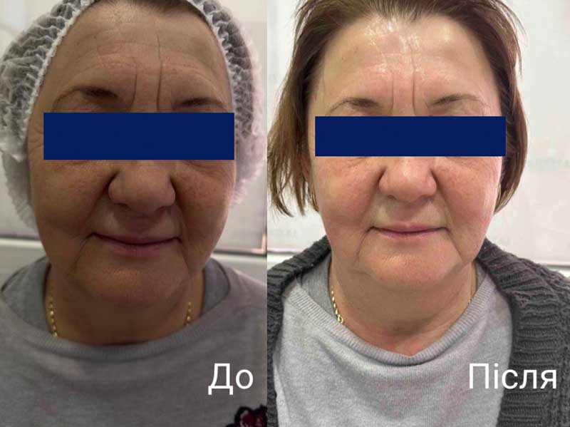 SMAS-лифтинг (Блюр-15) — результат до/после
