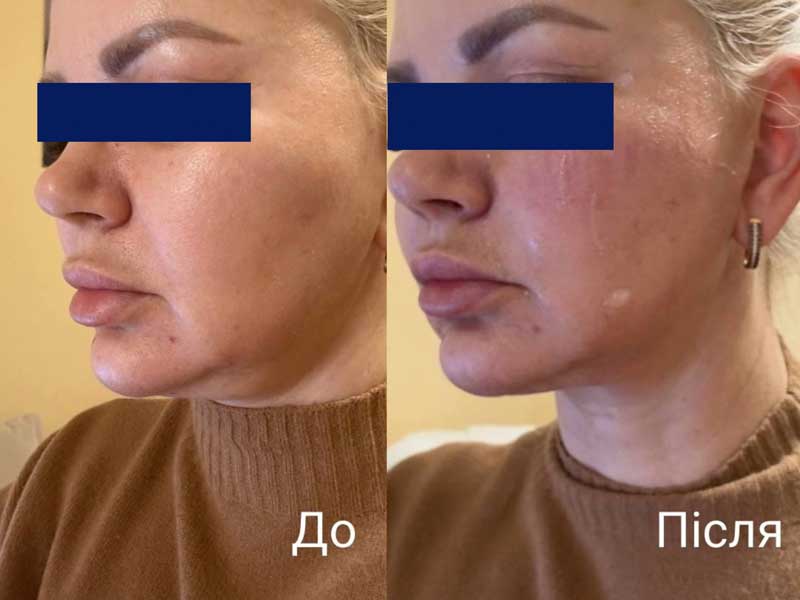 SMAS-лифтинг (Блюр-16) — результат до/после