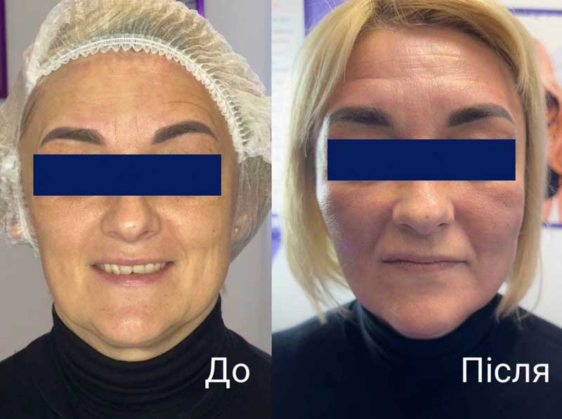 SMAS-лифтинг (Блюр-17) — результат до/после