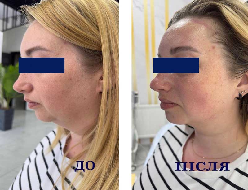 SMAS-лифтинг (Блюр-18) — результат до/после