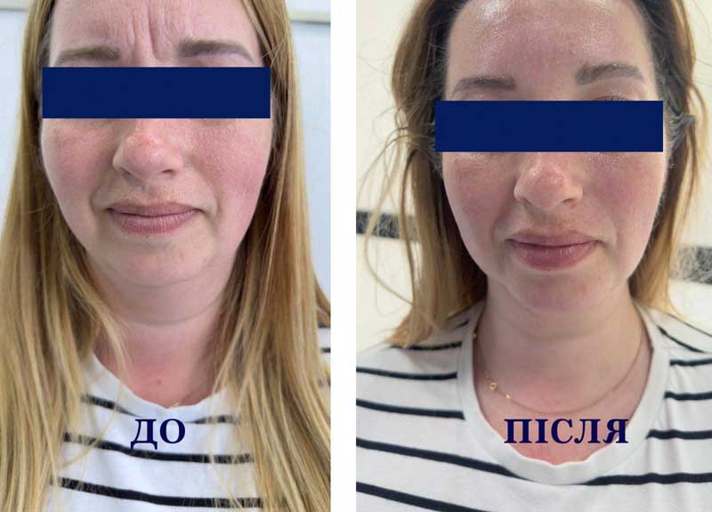 SMAS-лифтинг (Блюр-19) — результат до/после