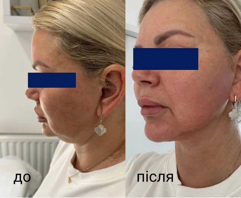 SMAS-лифтинг (Блюр-20) — результат до/после