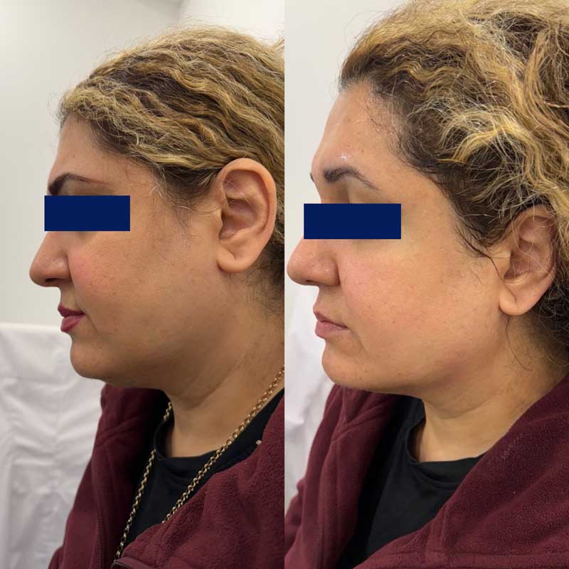 SMAS-лифтинг (Блюр-21) — результат до/после