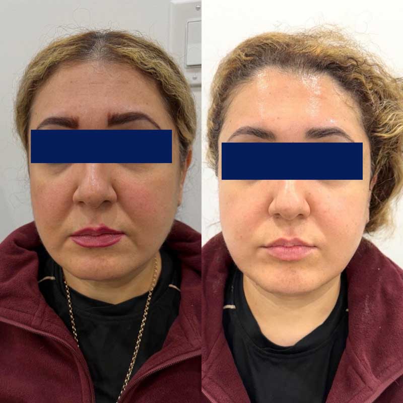 SMAS-лифтинг (Блюр-22) — результат до/после