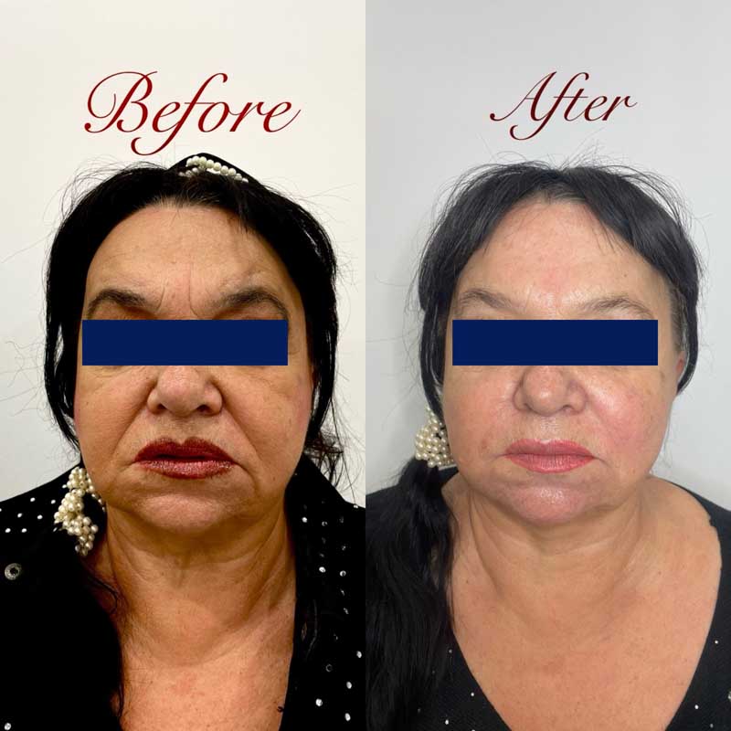 SMAS-лифтинг (Блюр-3) — результат до/после