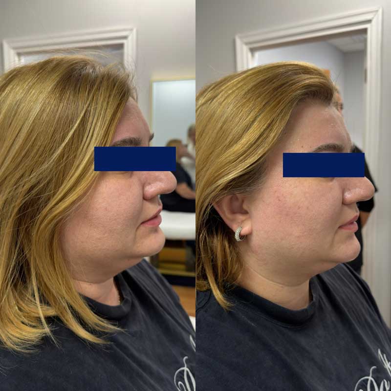 SMAS-лифтинг (Блюр-4) — результат до/после