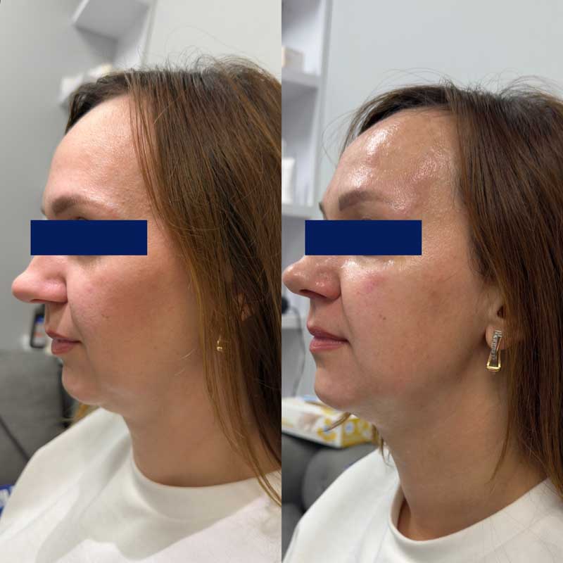 SMAS-лифтинг (Блюр-5) — результат до/после