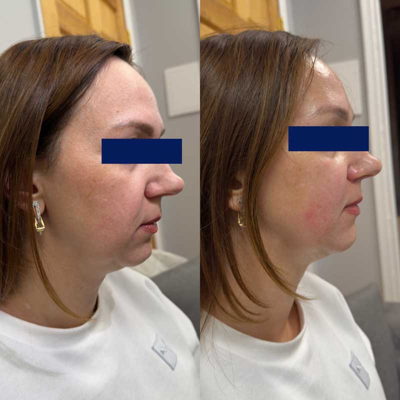 SMAS-лифтинг (Блюр-6) — результат до/после