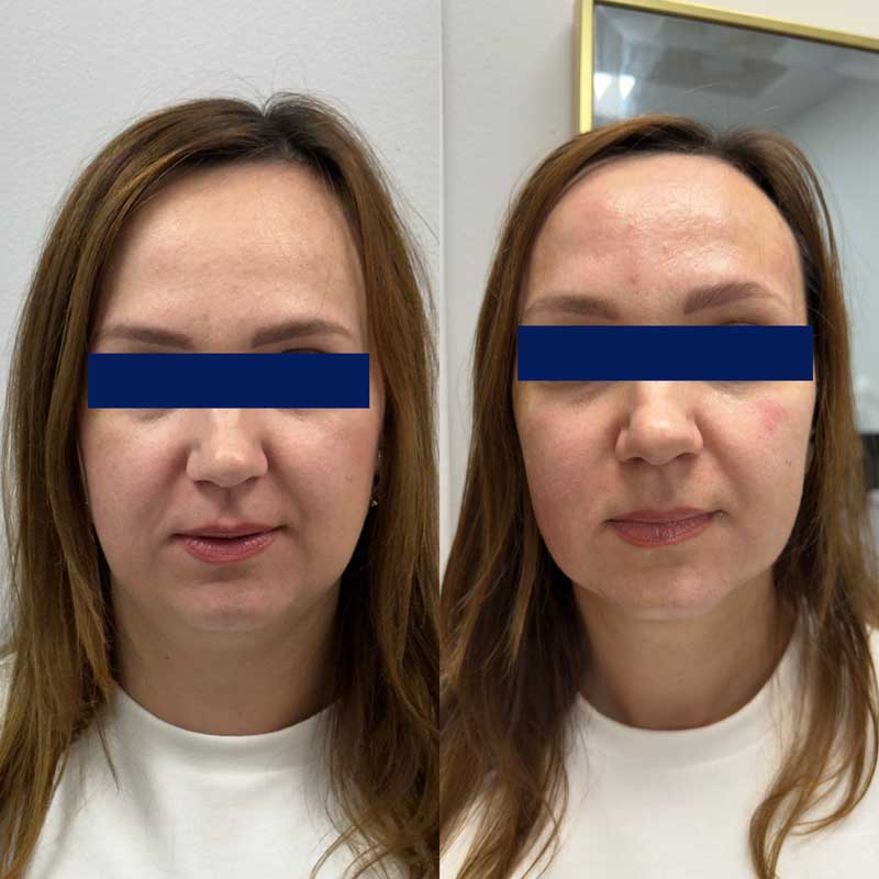 SMAS-лифтинг (Блюр-7) — результат до/после