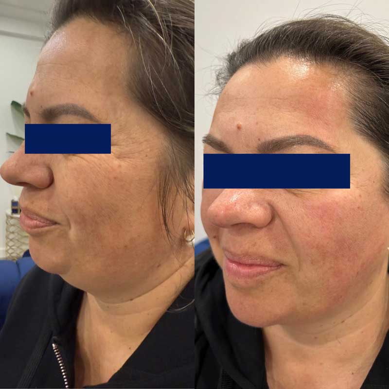 SMAS-лифтинг (Блюр-8) — результат до/после