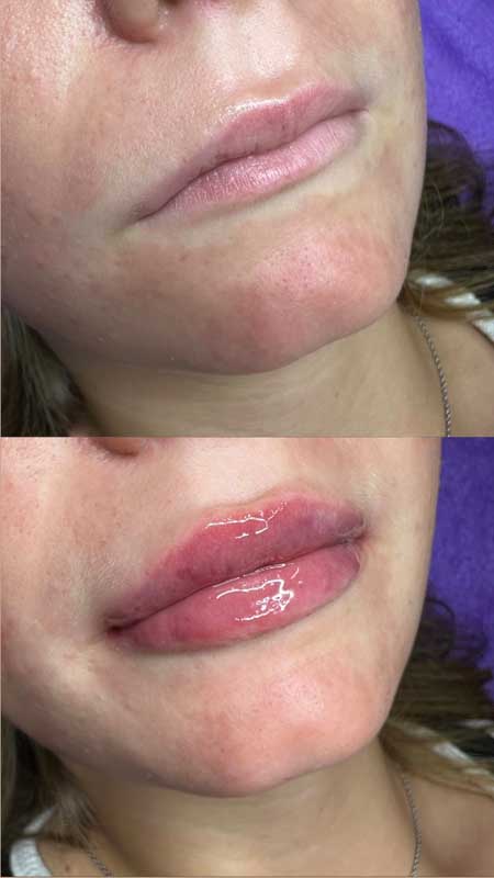 Контурная пластика губ 5 — результат до/после
