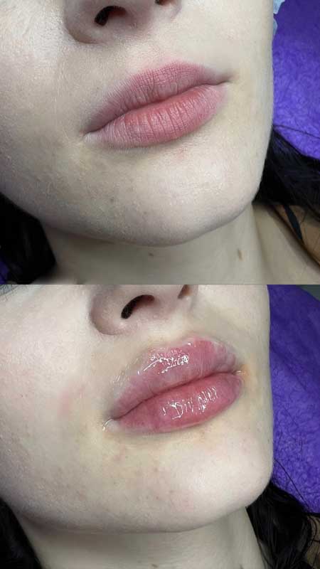 Контурная пластика губ — результат до/после