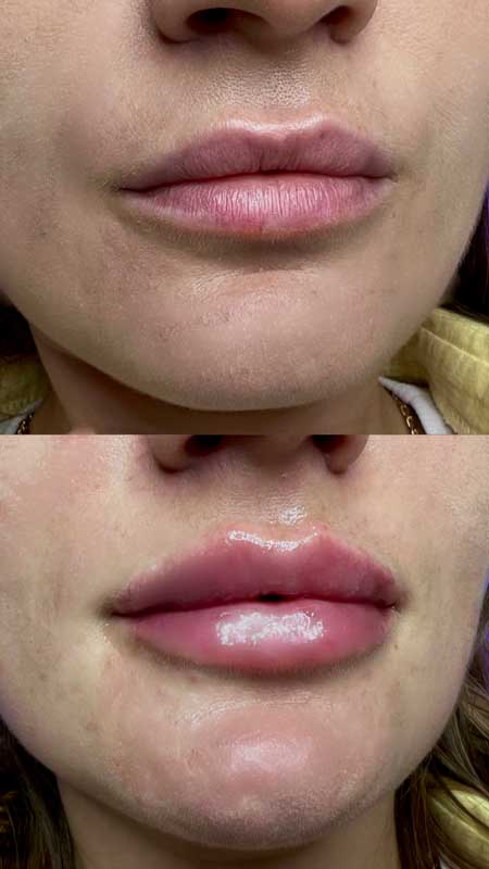 Контурная пластика губ 2 — результат до/после