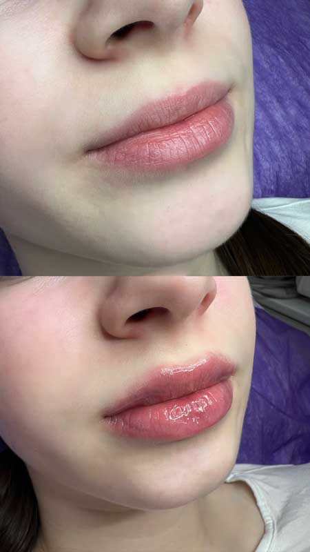Контурная пластика губ 3 — результат до/после