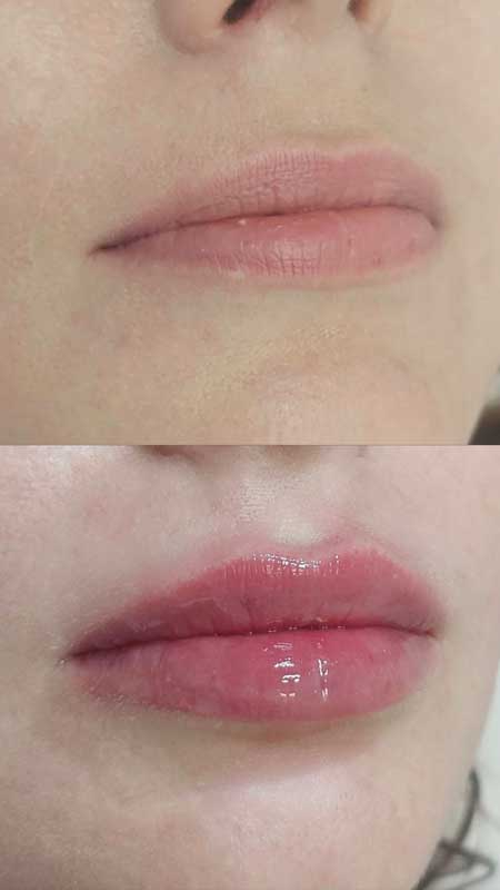 Контурная пластика губ 4 — результат до/после