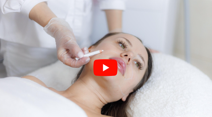 Разметка зон для лазерной эпиляции